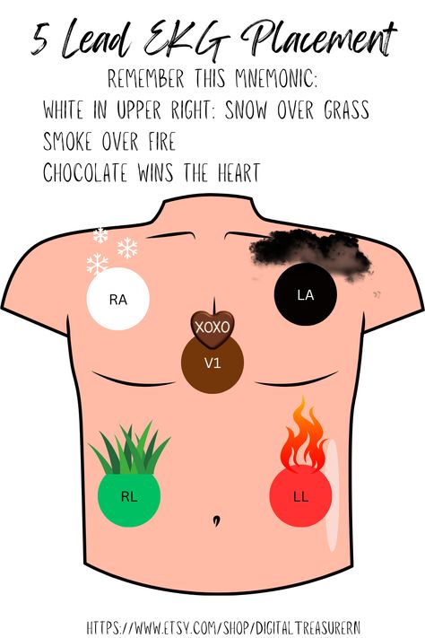 Ekg Leads Placement, Telemetry Lead Placement, Ekg Lead Placement, Ekg Placement, Lead Placement, Ekg Leads, Telemetry Nursing, Emt Study, Nurse Study