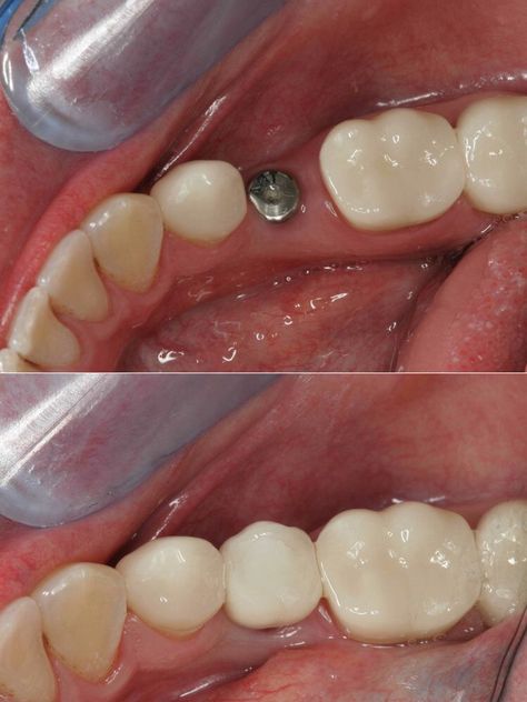 Dental implants are the preferred method of replacing a missing tooth because you can brush and floss around it more easily than a bridge. Dental Bridge Cost, Tooth Extraction Aftercare, Tooth Implant, Tooth Extraction Healing, Affordable Dental Implants, Dental Implant Procedure, Bridge House, Dental Implants Cost, Dental Facts