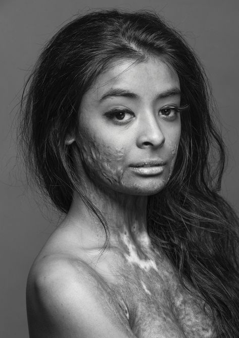 This beautiful model, a burn survivor, did this photo shoot to, in her own words, "prove that scars do not change a person, they make that person who they become." Warrior Women, Story Board, We Are The World, People Of The World, Interesting Faces, Inspirational People, Look At You, People Around The World, Inspirational Women