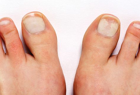 Pictures of Toenail Colors and What They Mean How To Whiten Toenails, White Patches On Toenails, Toenail Whitening, White Spots On Toenails, Toenail Color, White Toenail, Toenail Colors, Best Toe Nail Color, Toenail Problems