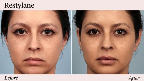 Radiesse vs. Restylane: Comparing the Two Dermal Fillers Radiesse Before After, Restylane Before And After, Restylane Lyft, People With Hiv, Tear Trough, Numbing Cream, Lip Augmentation, Back Of Hand, Injectables Fillers