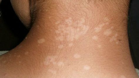 White Skin Patches, White Skin Spots, Pigmentation Remedy, Sun Spots On Skin, Brown Spots On Skin, Skin Marks, Skin Grafting, Scaly Skin, Skin Patches