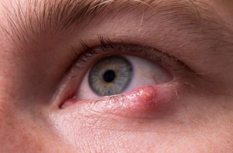 As frightening as it maybe to discover a pimple on your eye, it's quite normal and you can treat it right at home. Here's everything you need to know about why you're experiencing an eye stye and how to treat it. Stye Causes, Painful Pimple, Hypoallergenic Makeup, Computer Vision Syndrome, How To Get Rid Of Pimples, Eyes Problems, Dry Eyes, Pink Eyes, Eye Health