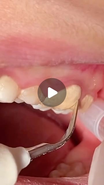 Dentistry World on Instagram: "Scaling of tartar & calculus from teeth 🦷   @dr.morad.shaglouf" How To Remove Tartar From Teeth, Tarter Build Up Removal, Tartar Removal From Teeth, Removing Tartar From Teeth, Scaling Teeth, Teeth Tartar Removal, Tartar Teeth, Tartar Removal, Tooth Cavity