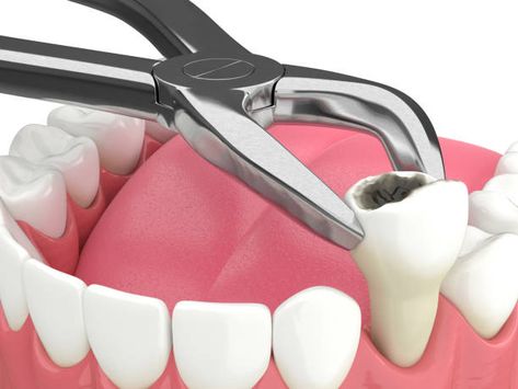 Otherwise known as caries or tooth decay, a cavity is a hole in the tooth. It is an opening on the hard surface of the tooth enamel that constantly expends unless it is treated. There are many reasons why cavities develop. Usually, it is a lack of dental hygiene. Clove Dental, Dental Extraction, Tooth Pulled, Wisdom Tooth Extraction, Wisdom Teeth Removal, Tooth Removal, Teeth Implants, Tooth Extraction, Dental Procedures