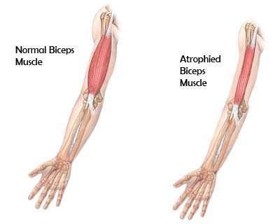 http://alphadogg16.hubpages.com/hub/Muscle-Atrophy Nighttime Leg Cramps, Hand Tremors, Thoracic Outlet, Kidney Function Test, Tremors Hand, Muscle Atrophy, Shoulder Surgery, Nerve Damage, Medical History