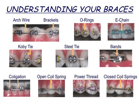 Braces vocabulary and diagram.  This could be very helpful Orthodontics Memes, Orthodontics Assistant, Braces Meme, Braces Hacks, Orthodontist Assistant, Braces Problems, Braces Humor, Orthodontic Assistant, Dental Infographics