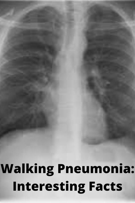 In children and teenagers, walking pneumonia is very frequent. Pneumonia Remedies Children, Walking Pneumonia Remedies, Mycoplasma Pneumonia, Pneumonia In Children, Remedies For Pneumonia, Pneumonia Remedies, Signs Of Pneumonia, Walking Pneumonia Symptoms, Pneumonia In Kids