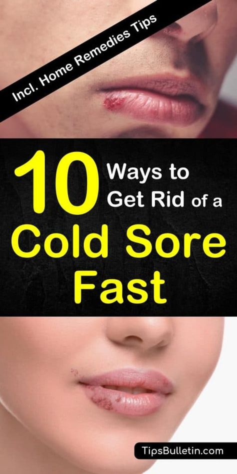 Get Rid Of Cold, Fever Blister, Canker Sore, Cold Sores Remedies, Cold Symptoms, Natural Antibiotics, Cold Sore, Simple Home, Rubbing Alcohol