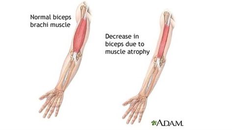 Atrophy Muscle, Muscle Wasting, Runners Legs, Muscle Atrophy, Wind Blowing, Legs Day, Leg Workout, Nook, Nursing