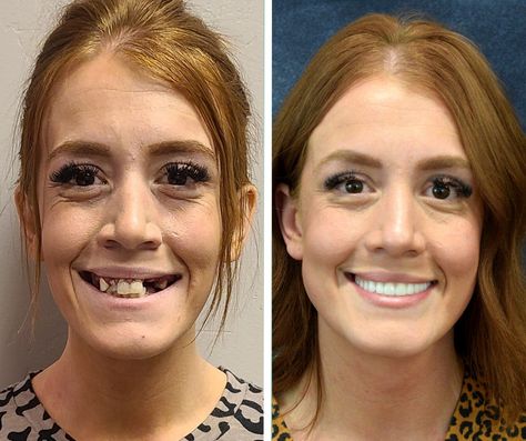 before image of woman with missing and crooked teeth and after image of her new, fixed smile Tooth Implant, Dental Implants Before And After, Dental Implant, Jaw Reduction Surgery, Korean Plastic Surgery, Implant Dentist, Plastic Surgery Fail, Face Surgery, Plastic Surgery Gone Wrong