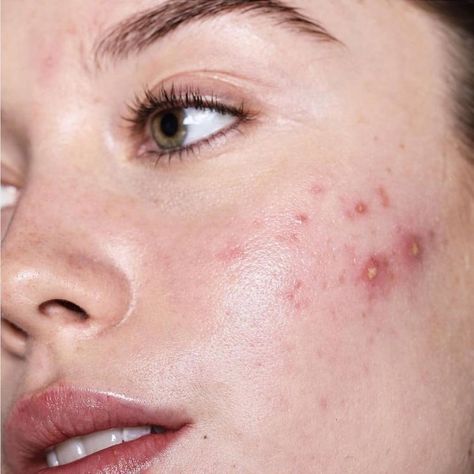 Acne Positivity, Nodular Acne, Remove Skin Tags Naturally, Face Mapping Acne, Nuh Uh, Face Mapping, Natural Acne, Acne Causes, Oil Spill