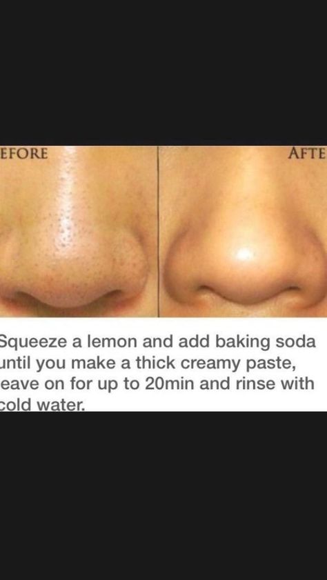 Blackhead Remover Diy, Face Mask For Blackheads, Honey Face Mask, Blackhead Mask, Honey Face, Healthy Fruit, Cold Sores Remedies, Natural Sleep Remedies, Natural Cold Remedies