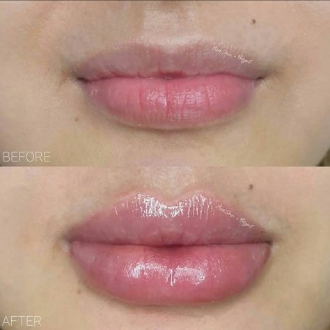 Bottom Lip Filler, Heavy Bottom Lip, Lip Filler Technique, Nose Jobs, Rhinoplasty Nose Jobs, Lip Augmentation, Lip Filler, Lip Enhancement, Bottom Lip