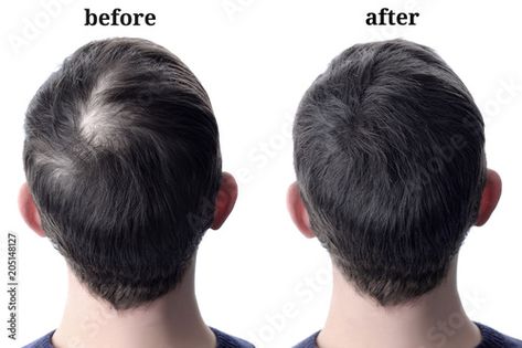 Stock Image: Men'shair after using cosmetic powder for hair thickening. Before and after Dunner Wordend Haar, Regrow Hair Naturally, Rapid Hair Growth, Bald Spot, Best Hair Transplant, Regrow Hair, Hair Thickening, Hair Restoration, Hair Regrowth