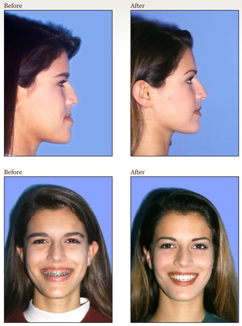 The upper jaw was repositioned upward and forward and the lower jaw was set back to correct the underbite and to improve profile, smile and appearance. Jaw Surgery Before And After Underbite, Upper Jaw Surgery, Underbite Before And After, Double Jaw Surgery Before And After, Underbite Braces, Jaw Surgery Before And After, Overbite Before And After, Braces Before And After, Jaw Reduction Surgery