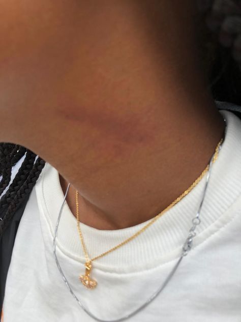 Fake Black Girlfriend Snaps No Face, Hickey Neck Aesthetique, Neck Full Of Hickeys, Hicks On Neck, Hickies Neck Aesthetic, Hickies Neck, Cuddle With Boyfriend, Groom Reaction, Black Love Couples