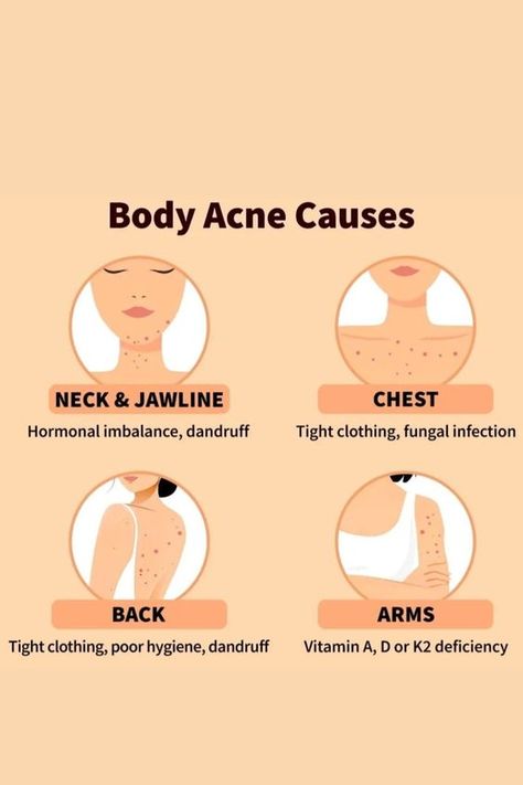 body acne causes, acne Bad Acne, Skin Advice, Clear Healthy Skin, Acne Skincare, Natural Face Skin Care, Natural Acne Remedies, Types Of Acne, Acne Causes, Body Acne