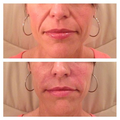 Deep Nasolabial, Nasolabial Folds, Smile Lines, Deep Wrinkles, Dermal Fillers, Being Used, Wrinkles, On Instagram, Beauty