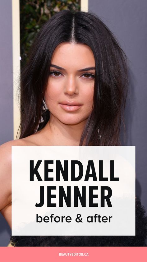 Kardashians Before And After Surgery, Kendall Jenner Before And After Surgery, Kendall Jenner Plastic Surgeries, Kendall Jenner Before And After, Kylie Jenner Before And After, Kendall Jenner Nose, Kybella Before And After, Kardashians Before And After, Khloe Before And After