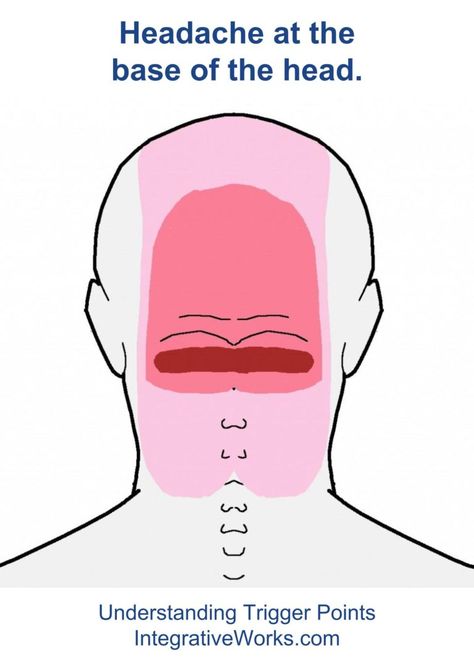 Understanding Trigger Points - Headache at the base of the head that extends comes from the neck and extends up the back of the head. Therapist Notes, Occipital Neuralgia, Headache Relief Instant, Headache Prevention, Natural Headache Remedies, Back Of Head, Trigger Point Therapy, Head Pain, Chronic Migraines