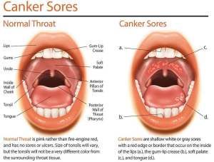 Throat Ulcers, Canker Sore Causes, Blister Remedies, Mouth Blisters, Canker Sore Relief, Canker Sore Remedy, Tongue Sores, Fever Blister, Soft Palate