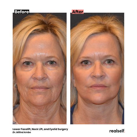 #Eyelidsurgery removes or tightens sagging skin around the eyes. Sagging Eyelids Hooded Eyes, Under Eye Surgery Before And After, Hooded Eyes Surgery, Hooded Eye Lift Before And After, Hooded Eye Surgery Before And After, Eye Lid Surgery Before And After, Botox For Hooded Eyelids, Face Tightening Procedures, Hooded Eye Surgery