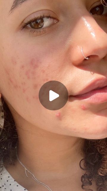 Cydney🧚🏽‍♀️ on Instagram: "Another one for my SKIN series 🤍✨ In depth video on my acne journey so far, when it all started, what I did & why I’ve decided to start a 6 month course of roaccutane with @tretdirect after years of failed attempts to get clear skin naturally 😬 Would love to know if you can relate to this journey & if you’ve taken roaccutane, how did you find it ? 😌" Get Clear Skin Naturally, Acne Journey, Clear Skin Naturally, Get Clear Skin, Content Inspiration, My Skin, Another One, Clear Skin, Halloween Fun