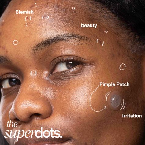 🌈 Embrace your imperfections this Acne Awareness Month! 🌟 Every spot, scar, and blemish tells a unique story. You are perfectly imperfect and absolutely beautiful! 💖 Acne Awareness Month, Acne Awareness, Perfectly Imperfect, Im Not Perfect, Acne