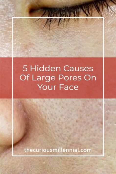 Big Pores On Face, Large Pores On Face, Large Pores On Nose, How To Close Pores, Make Pores Smaller, Huge Pores, Open Pores On Face, Pores On Face, Best Pore Minimizer