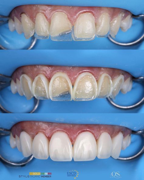 Dr.Osama Shaalan | Free hand palatal shell , unica frame before and after layering the veneering layer . Polished by lucida WDB composite ,SI2 + E +MP… | Instagram Teeth Makeover, Teeth Bonding, Dental Mouthguards, Dental Images, Remedies For Tooth Ache, Dental Videos, Dental Aesthetics, Aesthetic Dentistry, Improve Nutrition