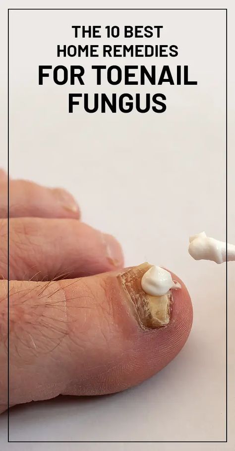 The 10 Best Home Remedies for Toenail Fungus Toenail Fungal Infection, Nail Remedies, Toenail Fungus Remedies, Nail Infection, Nail Fungus Remedy, Fungal Nail, Ingrown Toe Nail, Toenail Fungus, Nail Fungus