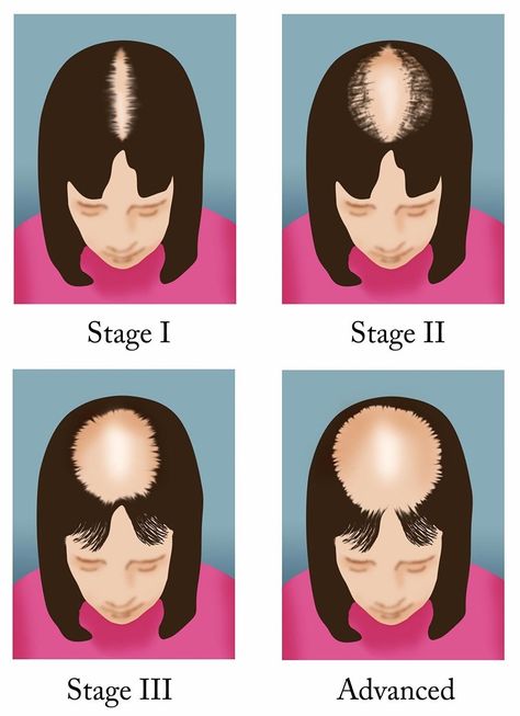 Alopecia Hairstyles, Female Pattern Baldness, Androgenetic Alopecia, Pattern Hair, Hair Specialist, Male Pattern Baldness, Hair Patterns, Pattern Baldness, Bald Hair