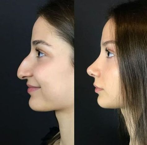 Bad Nose Jobs, Jaw Reduction Surgery, Nose Surgery Rhinoplasty, Nose Job Inspo, Ethnic Rhinoplasty, Nose Fillers, Dream Nose, Hooked Nose, Plastic Surgery Fail