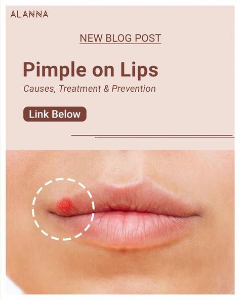 Pimples Around Lips, Pimples On Lip Line, Blister On Lip, What Causes Pimples, Deep Pimple, Lip Pimple, Zit Remedy, Inflamed Pimple, Redness Pimple