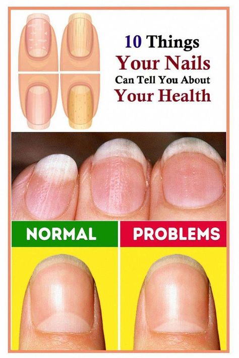 #RomanHairLossTreatment #WhatTongueSaysAboutHealth #NaturalRemediesForHairLoss #TongueHealthProblems #NailsHealth Healthy Toenails, Natural Hair Growth Remedies, Tongue Health, Castor Oil For Hair, Brown Spots On Face, Striped Nails, Natural Shampoo, Nail Health, Body Hair