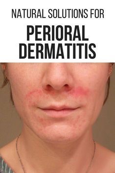 PERIORAL DERMATITIS: YOUR ULTIMATE GUIDE TO LONG-TERM HEALING Facial Rash Remedies, Dry Patchy Skin On Face, Redness Around Mouth, Exema Treatments For Face, Dry Red Patches On Face, Dry Bumpy Skin Face, Dry Red Skin On Face Remedies, Face Itching Remedies, Dry Red Skin On Face