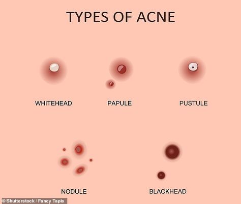 3 step routine for blackheads Redness Pimple, Chin Acne, Blind Pimple, Pimples Under The Skin, Esthetician Room, Face Care Routine, Types Of Acne, Hormonal Acne, Cystic Acne