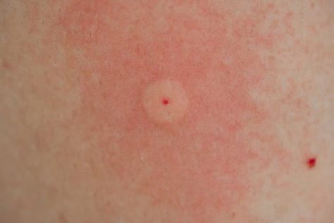 Identify the 10 Most Common Bug Bites in North America and How to Avoid Them | The Hearty Soul Bed Bug Bites Pictures, Spider Bites Pictures, Itchy Bug Bites, Ant Bites, Wasp Stings, Bed Bug Bites, Spider Bites, Kitchen Fun, Bee Sting