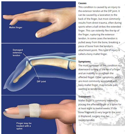 Mallet Finger - They may represent an isolated tendinous injury or occur in combination with an avulsion fracture of the dorsal base of the distal phalanx - untreated mallet finger or incomplete healing may progress to a swan neck deformity Swan Neck Deformity, Avulsion Fracture, Nbcot Exam, Mallet Finger, Finger Injury, Pa School, Swan Neck, Medical Anatomy, Hand Therapy