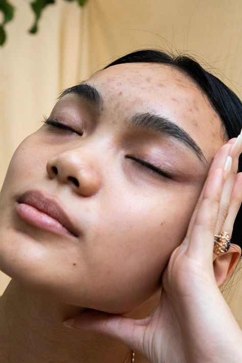 The “Skin Neutrality” Movement Is Growing — But I Can’t Get On Board #refinery29 https://www.refinery29.com/en-us/2019/12/8992367/skin-neutrality-positivity-acne Real Skin Aesthetic, Imperfect Skin Aesthetic, Acne Positivity Art, Strawberry Freckles, Real Skin Texture, Acne Aesthetic, Imperfect Skin, Beautiful Acne, Acne Pictures