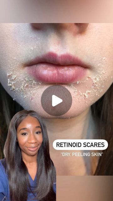 Kemi Fabusiwa on Instagram: "👩🏿‍⚕️ How to avoid the ‘retinol scaries’ with these top tips:  Retinoids are skin superstars, boosting collagen production, improving skin texture, fading dark spots, fixing acne, and reducing fine lines. By following these strategies, you can reap the benefits of retinoids and avoid the drying, peeling, irritation, and hypersensitivity known as the retinol scaries.  👩🏿‍⚕️ Use the retinol sandwich method: apply moisturizer before and after retinol to minimize irritation. 👩🏿‍⚕️ Go low and slow: gradually increase retinol concentration to build tolerance. 👩🏿‍⚕️ Avoid combining with other irritating actives to prevent overloading your skin.  #SkinCareTips #RetinolTips #HealthySkin #retinolsandwichmethod 💆🏿‍♀️✨" Before And After Retinol, Retinol Sandwich Method, Retinol For Sensitive Skin, How To Apply Retinol, Retinoids Before And After, Retin A Before And After, Tretinoin Before And After Acne, How To Use Retinol, Retinol Before And After