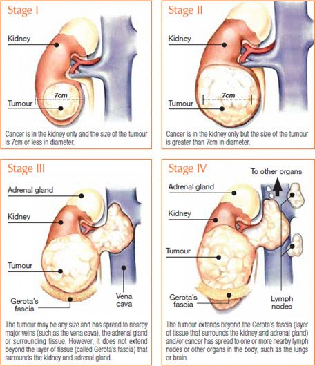 Renal Cell Carcinoma, Kidney Pain, Oncology Nursing, Medical Studies, Baking Soda Shampoo, Kidney Health, Medical Knowledge, Bangalore, Baking Soda