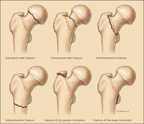 Fracture Types, Xray Anatomy, Orthopedic Nursing, Hip Fracture, Surgical Technologist, Radiology Technologist, Anatomy Physiology, Nursing School Notes, Human Anatomy And Physiology