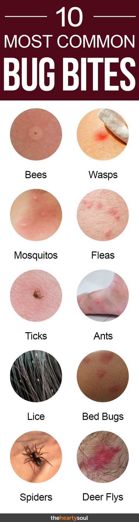 Bug bites can be itchy and frustrating, some can even be dangerous! Here’s how you can know quickly identify and treat your insect bites so you can go back to enjoying summer. #ticks #lyme Bug Bites Identifying, Types Of Bug Bites, Nature Knowledge, Bug Facts, Homesteading Animals, Wasp Stings, Types Of Bugs, Healthy Advice, Bug Bites