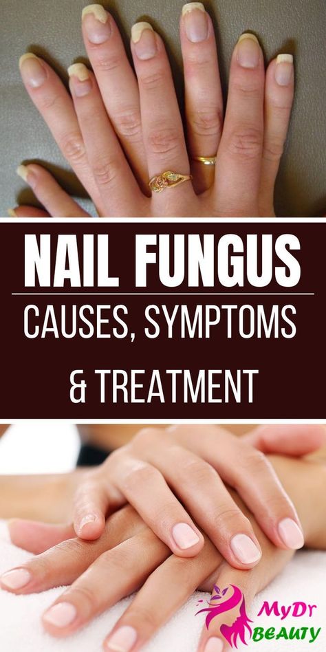 Healthy Nail Polish, Nail Remedies, Fingernail Fungus, Toenail Fungus Remedies, Girly Tingz, Nail Infection, Nail Fungus Remedy, Fungal Nail, Finger Nails