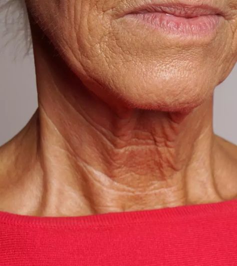 How to Prevent Neck Wrinkles? Chin Wrinkles, Saggy Neck, Neck Tightening, Wrinkle Free Skin, Natural Face Skin Care, Neck Wrinkles, Wrinkle Reduction, Skin Care Wrinkles, Acne Remedies