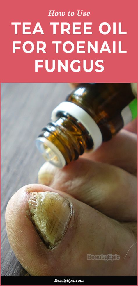 The 10 Best Home Remedies for Toenail Fungus Tea Tree Oil For Toenail Fungus, Nail Fungal Infection Toenails, Toe Nail Fungal Infection, Medical Remedies, Toenail Fungal Infection, Tea Tree Oil Uses, Nail Remedies, Natural Antifungal, Toenail Fungus Remedies