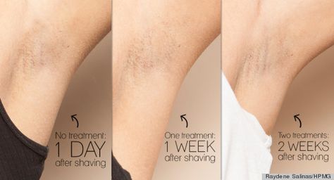 Why laser hair removal just might be worth every penny Laser Hair Removal Brazilian, Laser Hair Removal Cost, Best Laser Hair Removal, Hair Removal Diy, Hair Removal Methods, Ipl Hair Removal, Hair Removal Permanent, Hair Reduction, Unwanted Hair