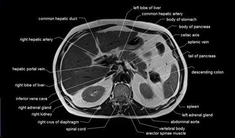 abdomen anatomy | MRI abdomen axial anatomy | free cross sectional anatomy | Mri Study Guide, Mri Anatomy, Superior Mesenteric Artery, Paranasal Sinuses, Abdominal Aorta, Radial Nerve, Mri Brain, Radiology Student, Anatomy Images